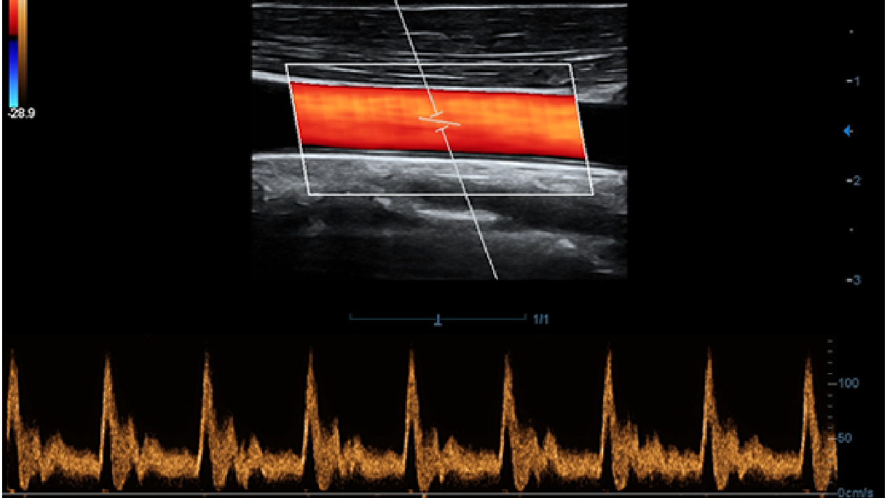 Клиническое изображение УЗИ аппарата Mindray DC-60 Pro X-Insight