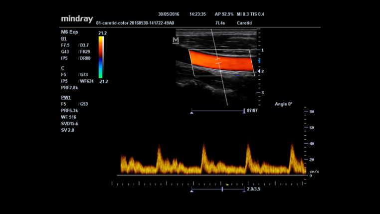 Клиническое изображение УЗИ аппарата Mindray Resona M6