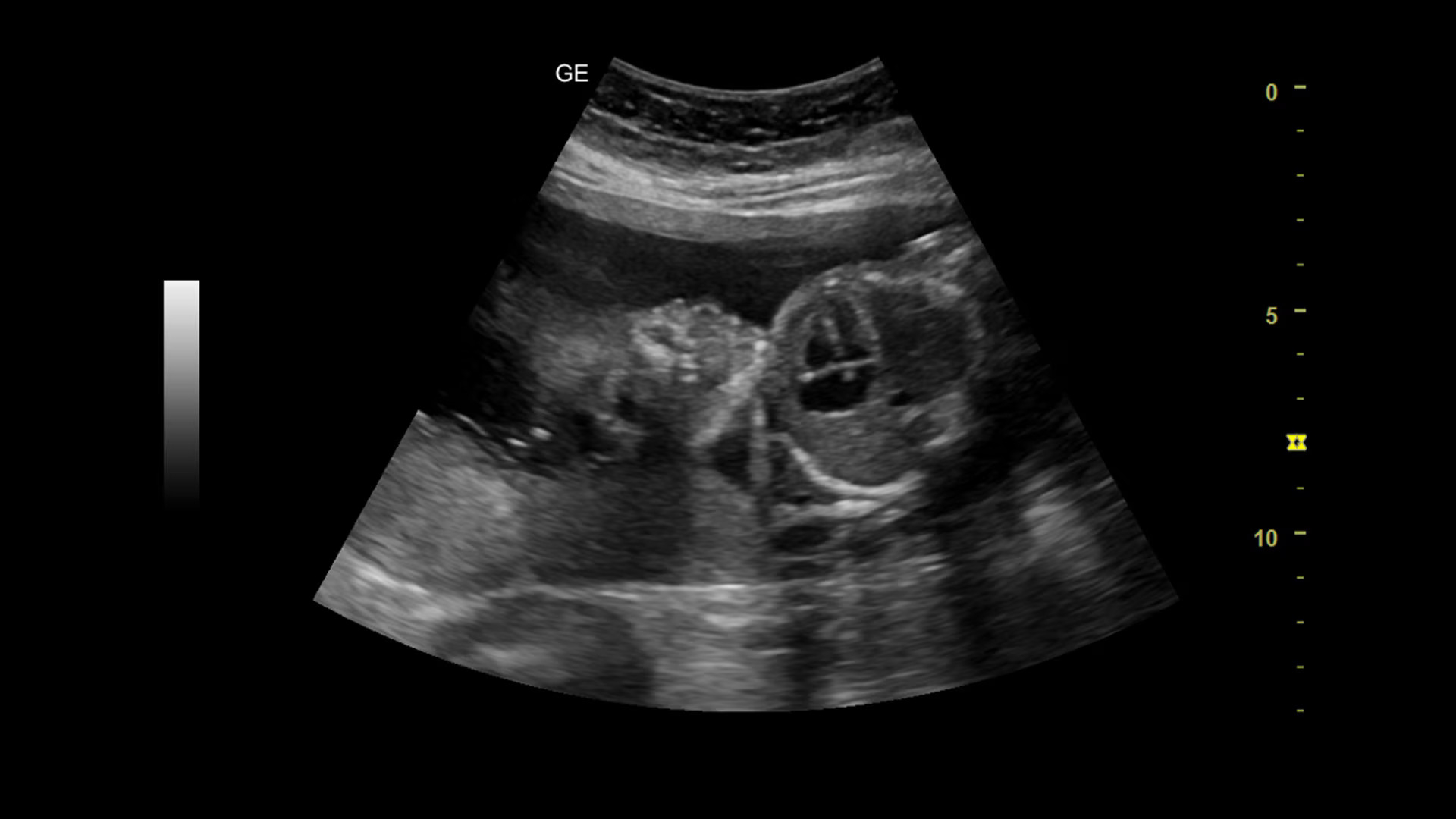Клиническое изображение УЗИ аппарата GE Versana Balance